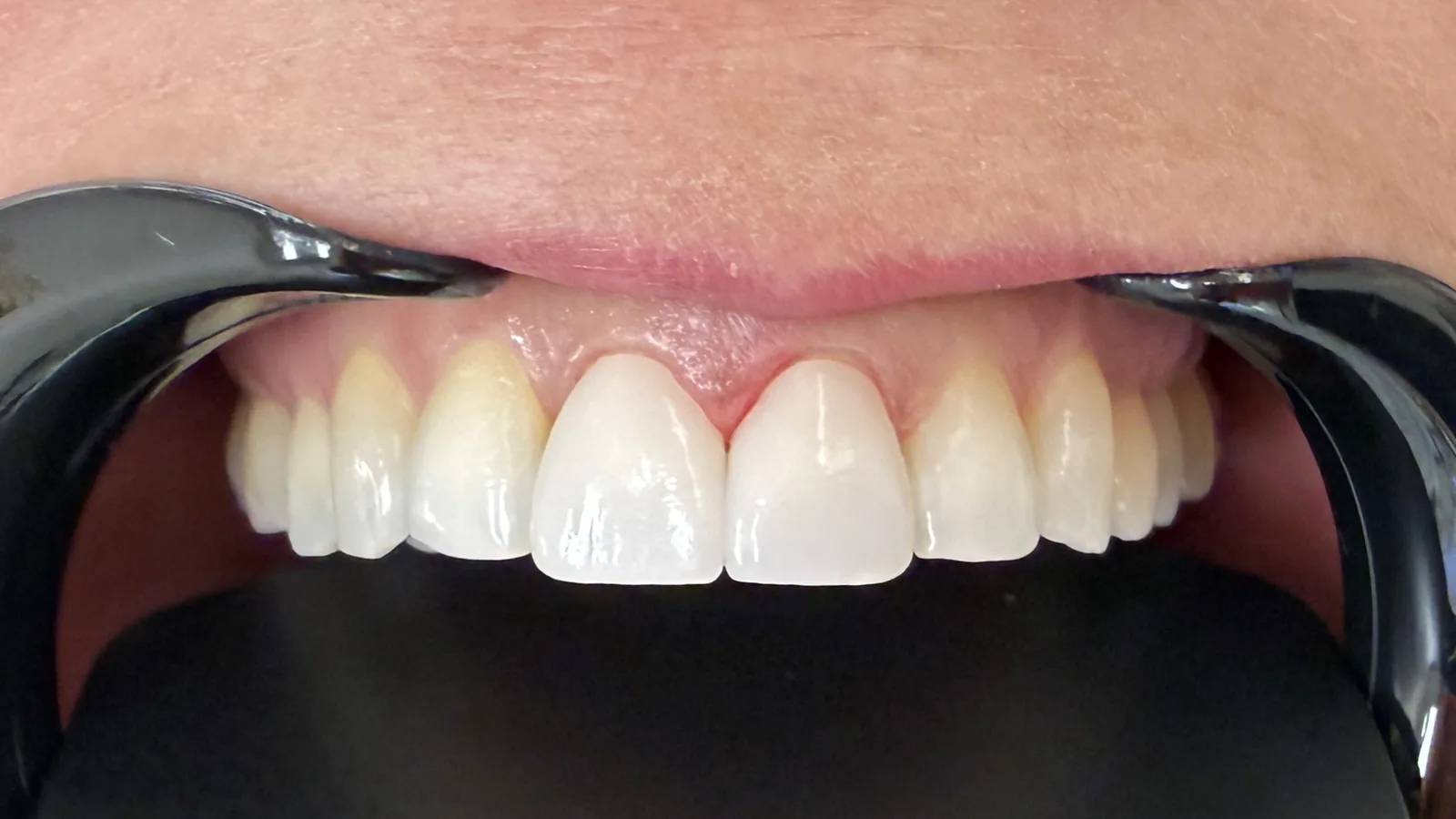 After — Cosmetic Crowns at 2C Wellness Dentistry