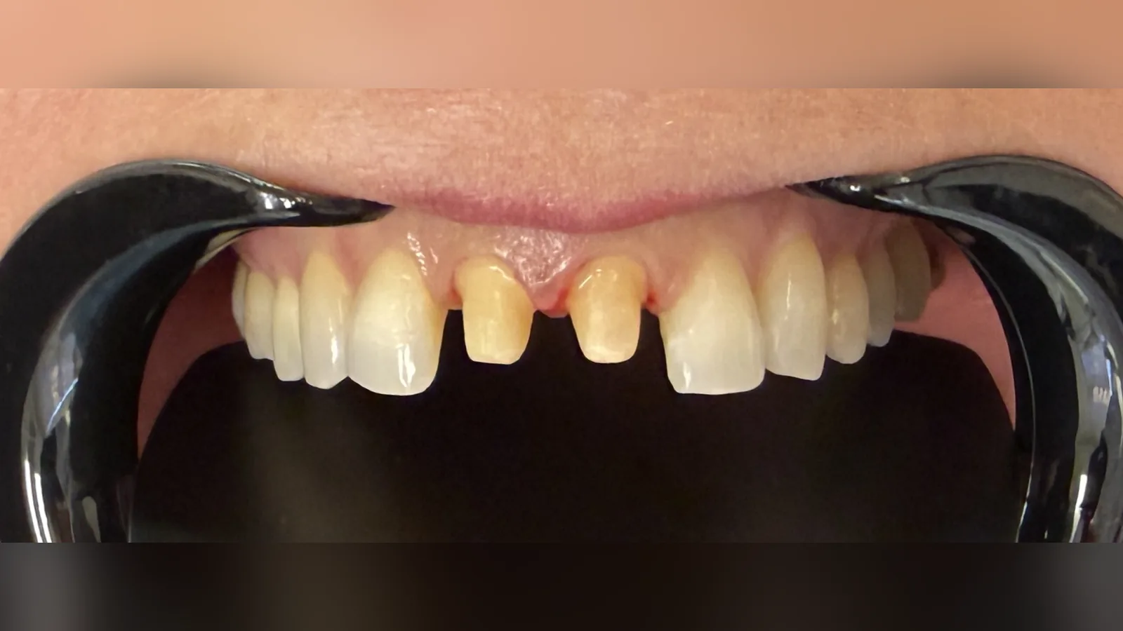 Before — Cosmetic Crowns at 2C Wellness Dentistry
