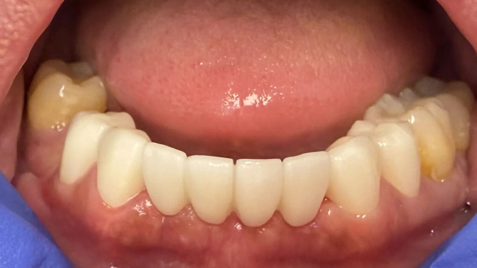 After — Full-Mouth Reconstruction at 2C Wellness Dentistry