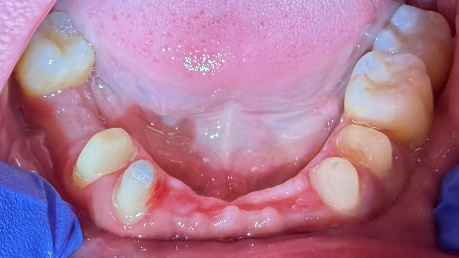 Before — Full-Mouth Reconstruction at 2C Wellness Dentistry
