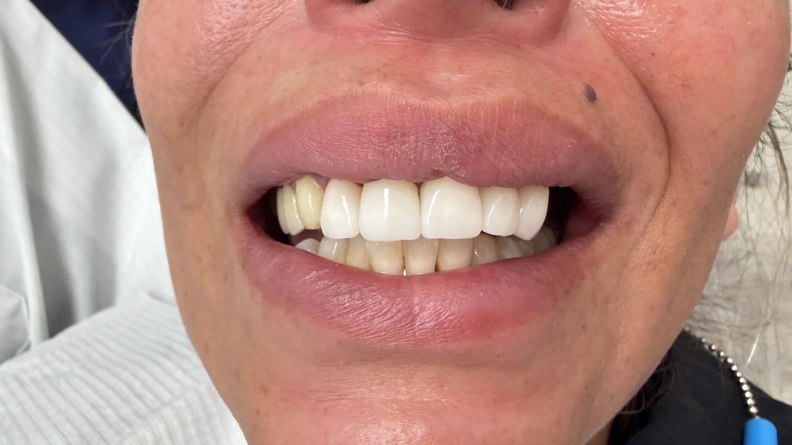 After — Full-Mouth Reconstruction at 2C Wellness Dentistry