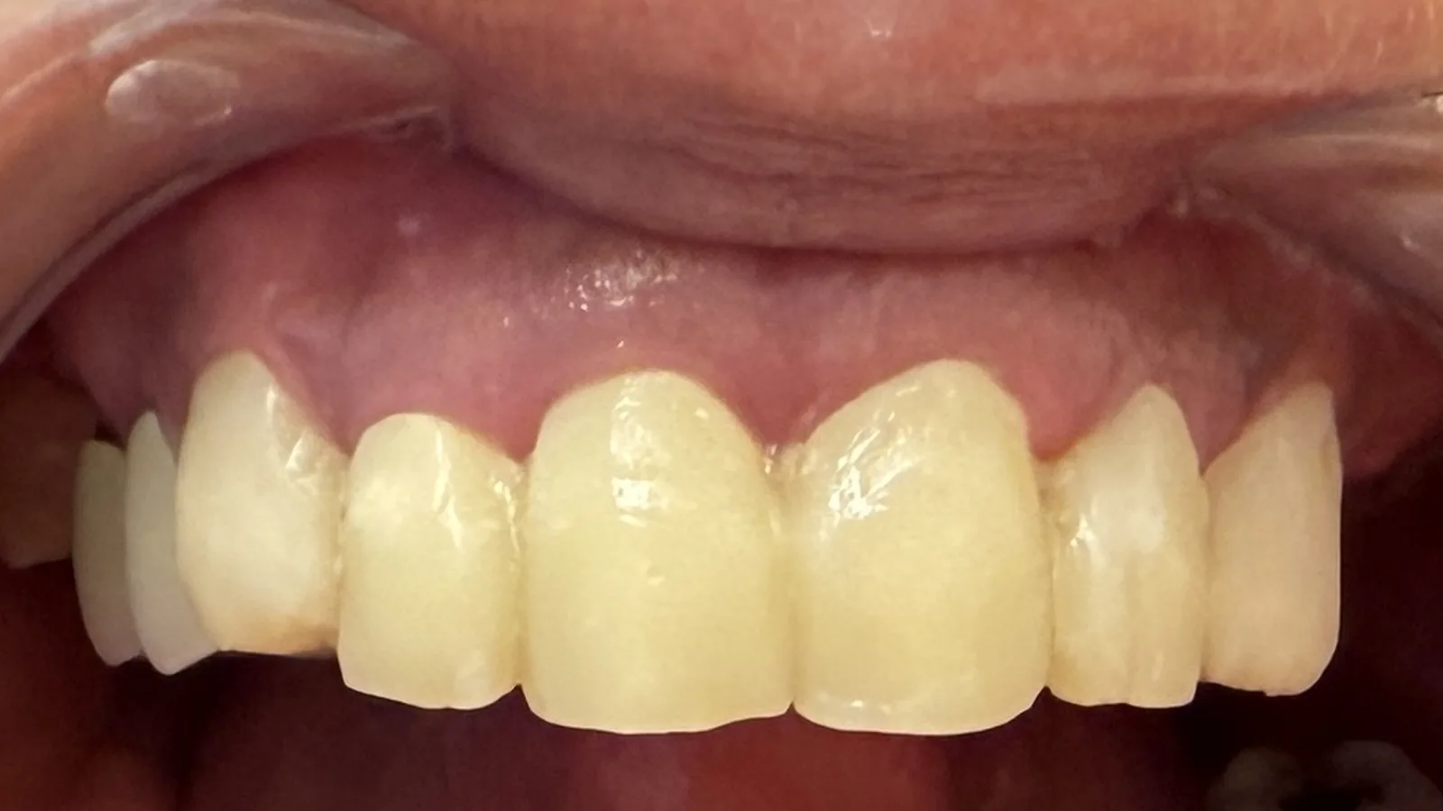 Before — Full-Mouth Reconstruction at 2C Wellness Dentistry