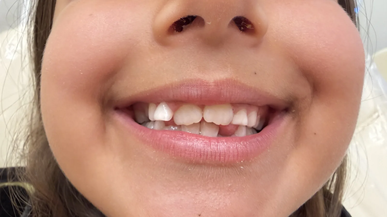 Before — Pediatric Dentistry at 2C Wellness Dentistry