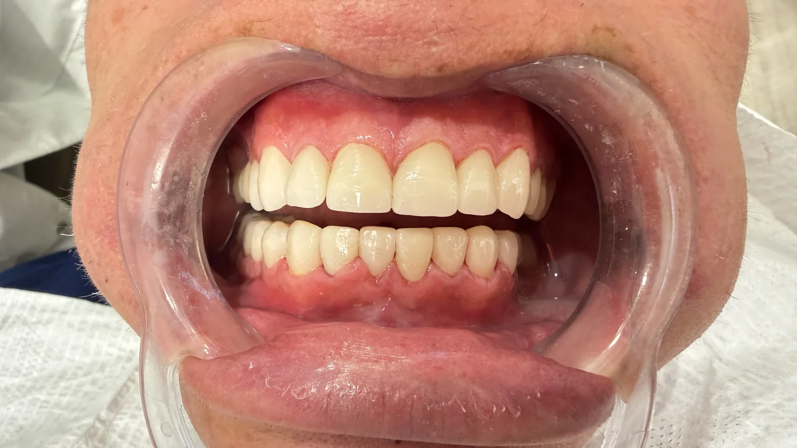 After — Porcelain Veneers at 2C Wellness Dentistry