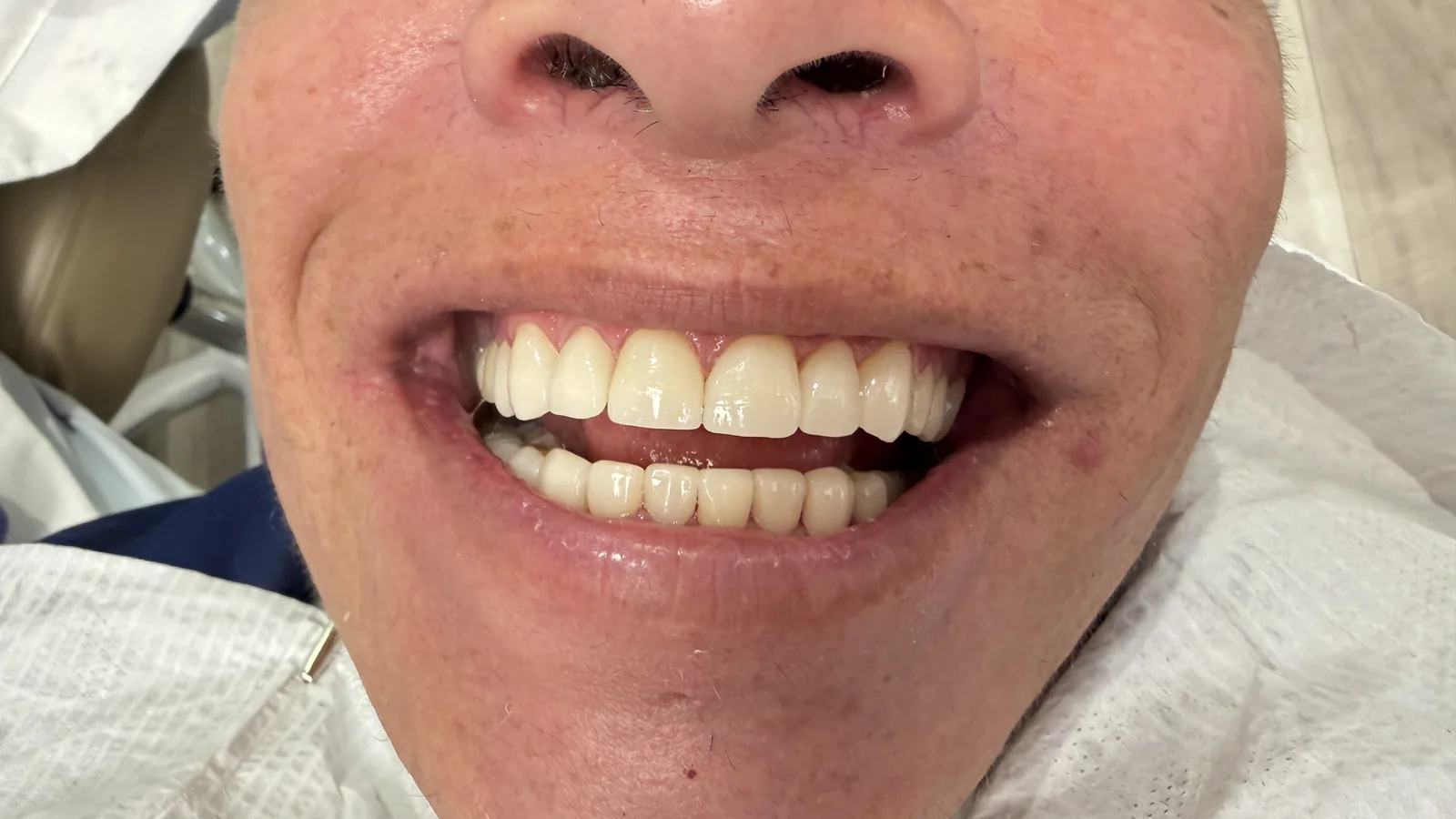 After — Porcelain Veneers at 2C Wellness Dentistry