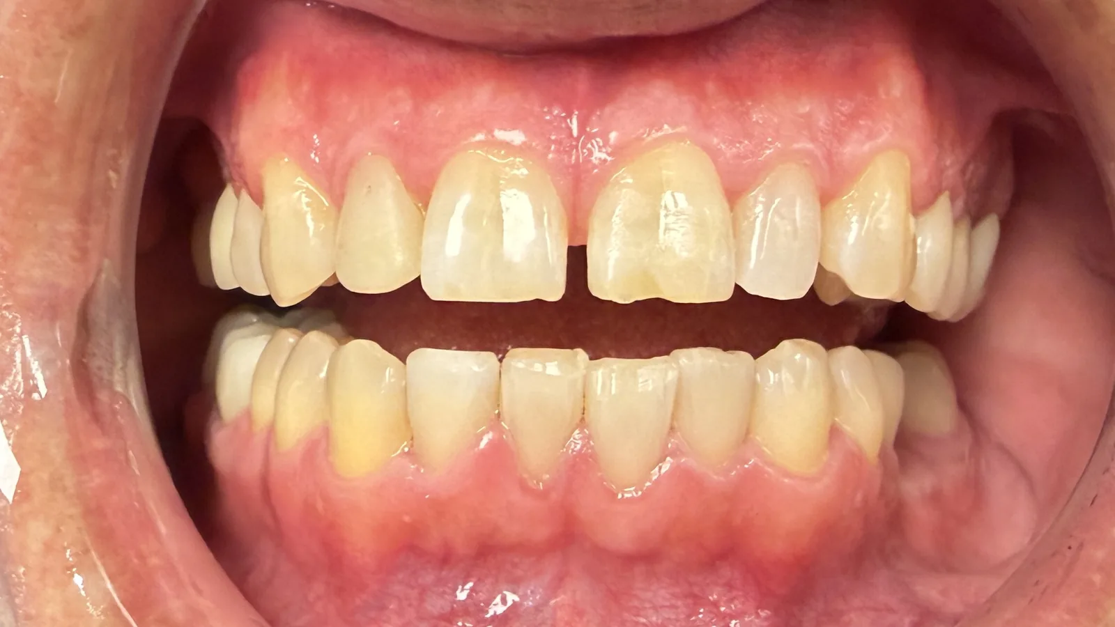 Before — Porcelain Veneers at 2C Wellness Dentistry