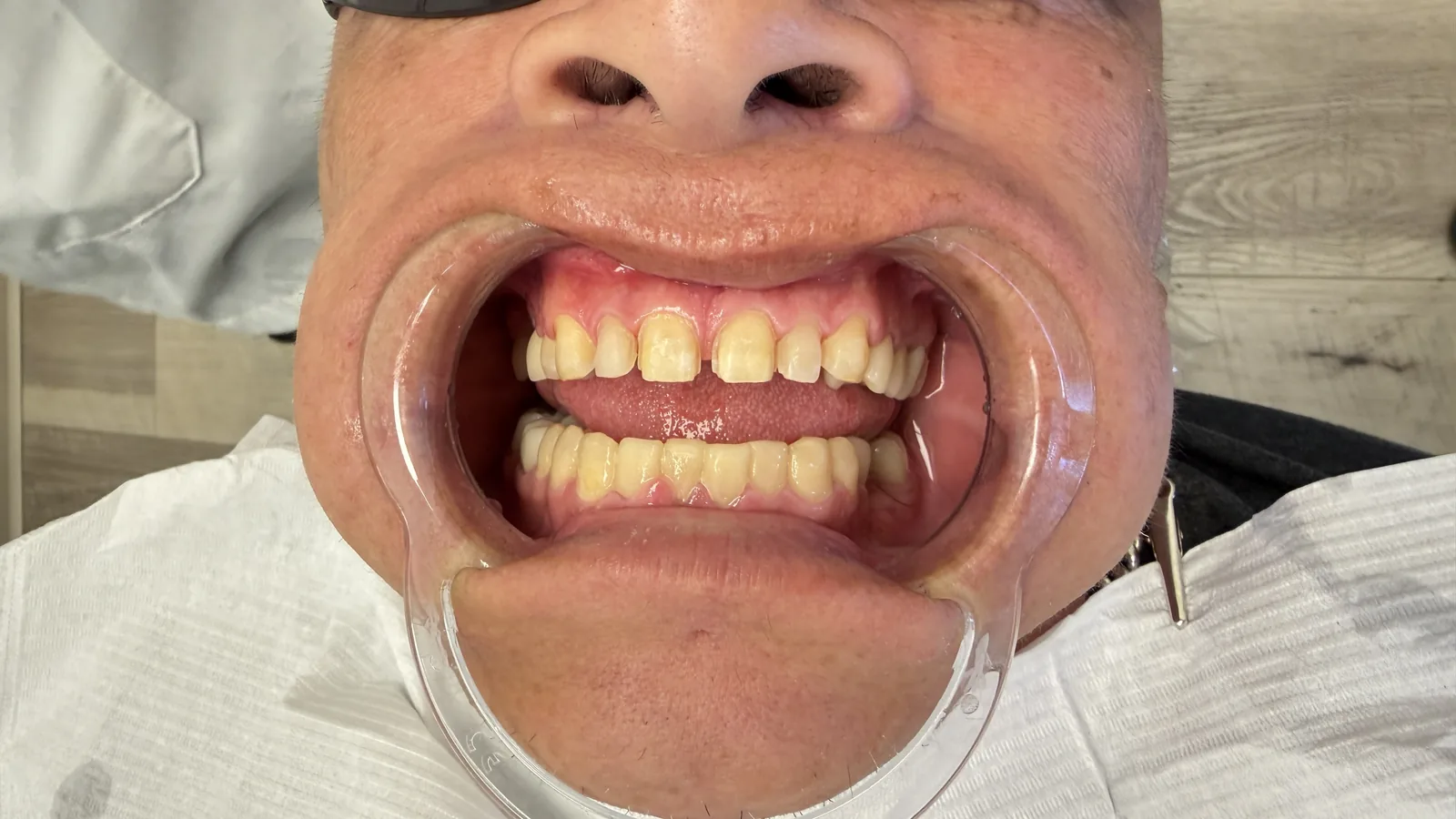 Before — Porcelain Veneers at 2C Wellness Dentistry