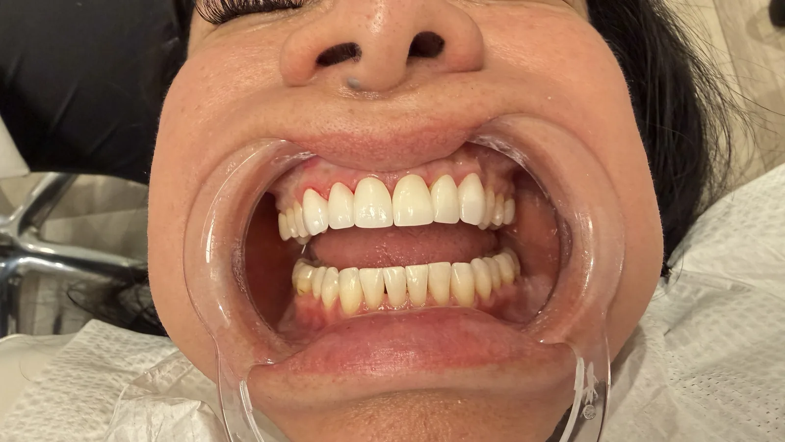 After — Porcelain Veneers at 2C Wellness Dentistry