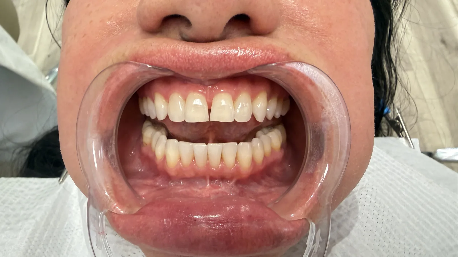 Before — Porcelain Veneers at 2C Wellness Dentistry