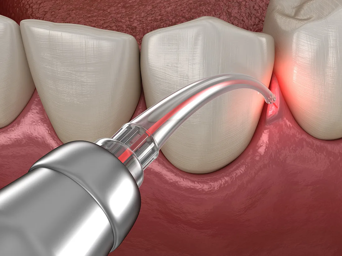 What is Soft-Tissue Laser Therapy