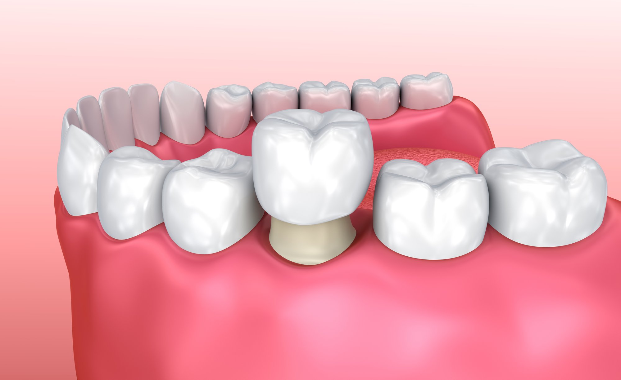 An all-ceramic dental crown with no metal core, matched to the natural teeth