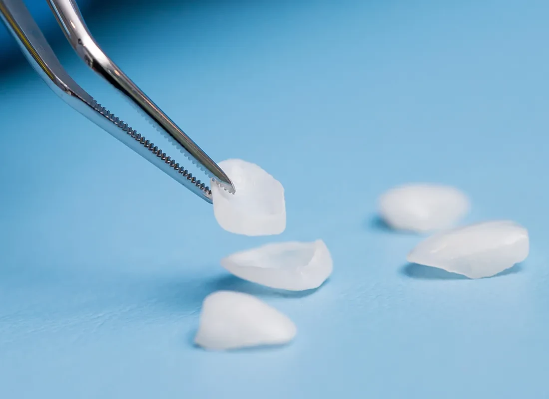What is Veneers