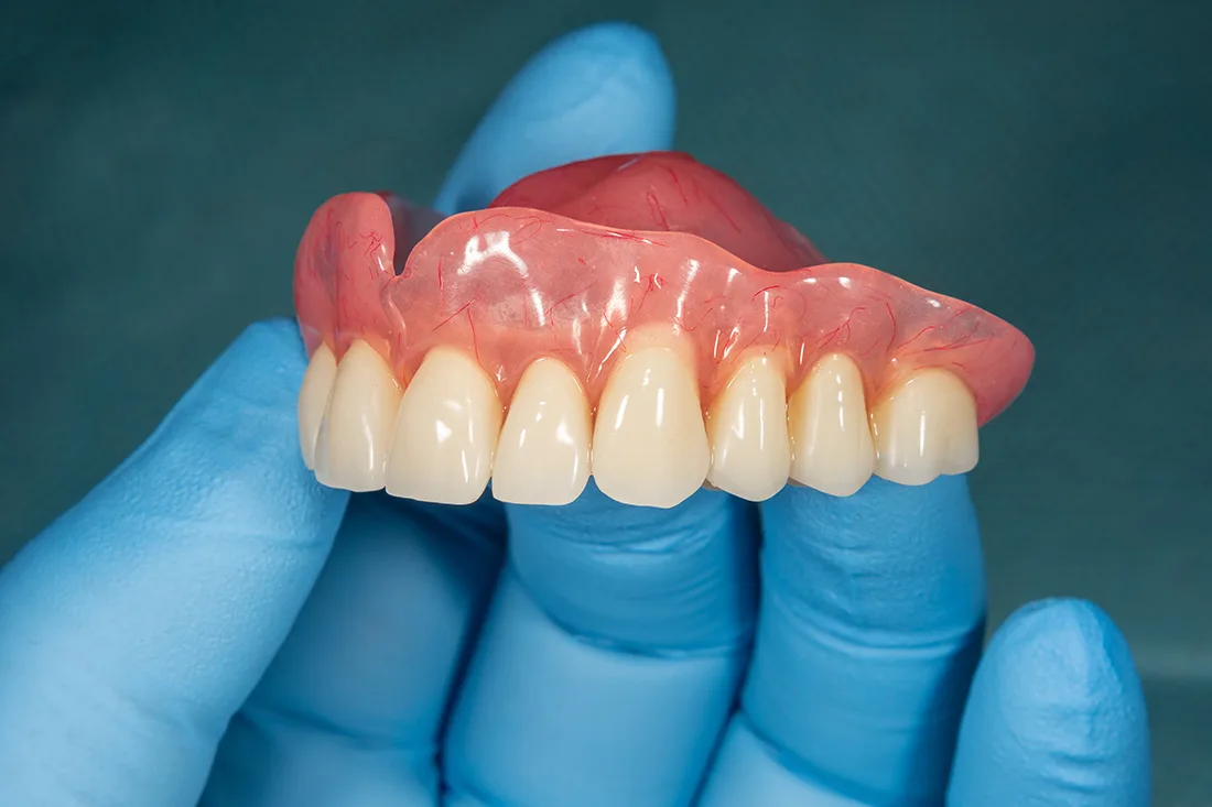 What is Dentures