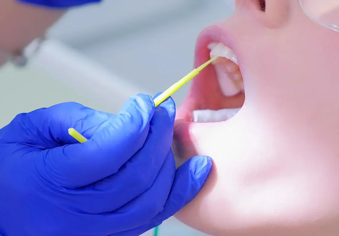 Fluoride Treatments