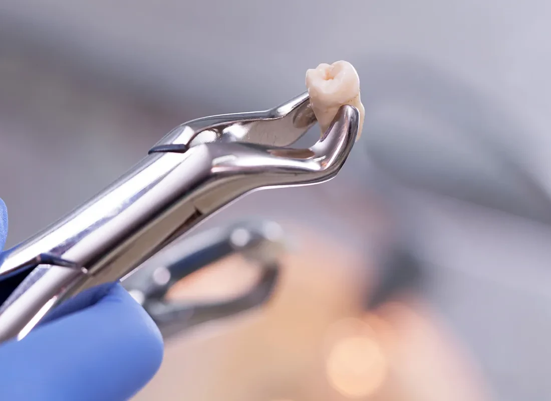What is Tooth Extractions
