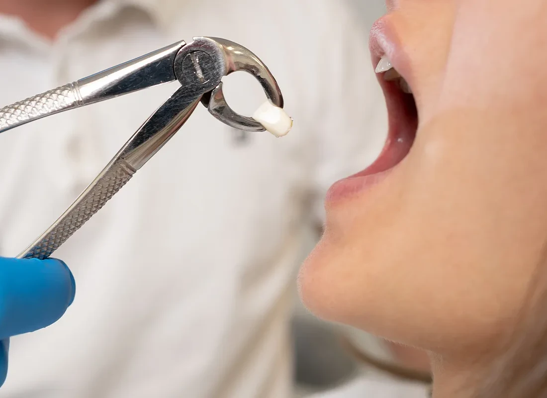 Wisdom Teeth Removal